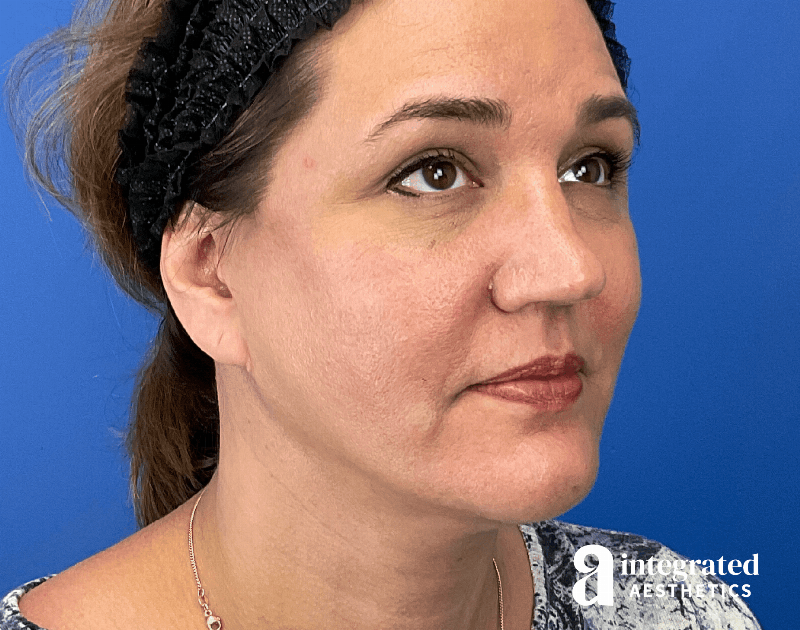 Facelift & Neck Lift Before & After Gallery - Patient 614844 - Image 4