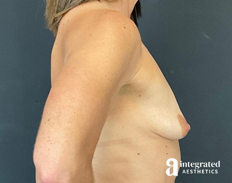 Breast Augmentation Before & After Gallery - Patient 395866 - Image 5