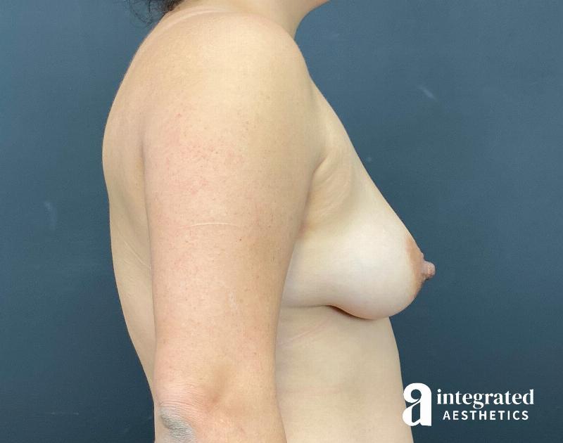 Breast Augmentation Before & After Gallery - Patient 230649 - Image 5