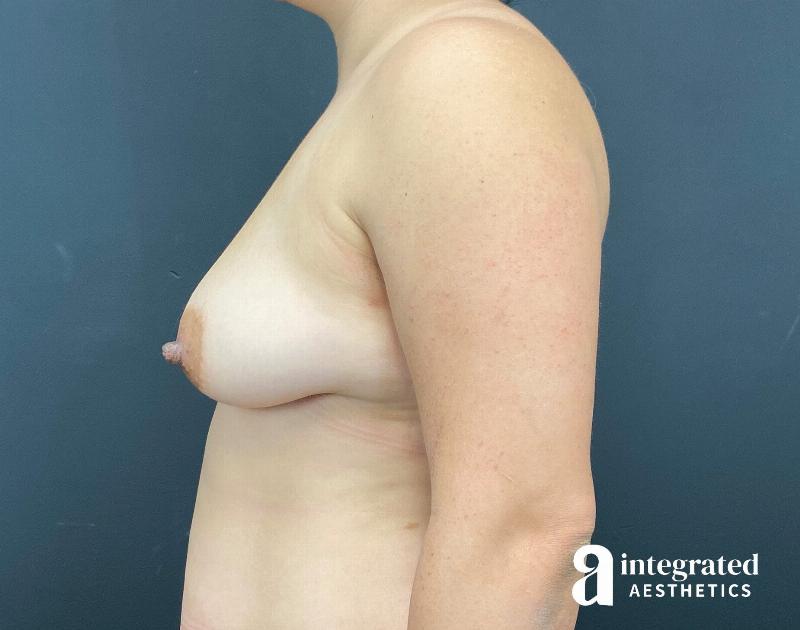 Breast Augmentation Before & After Gallery - Patient 230649 - Image 9