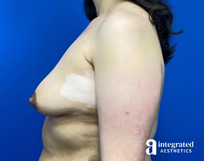 Breast Augmentation Before & After Gallery - Patient 107561 - Image 7