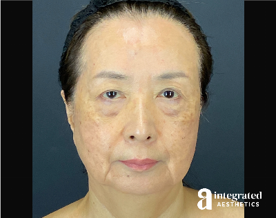 Facelift & Neck Lift Before & After Gallery - Patient 423746 - Image 1