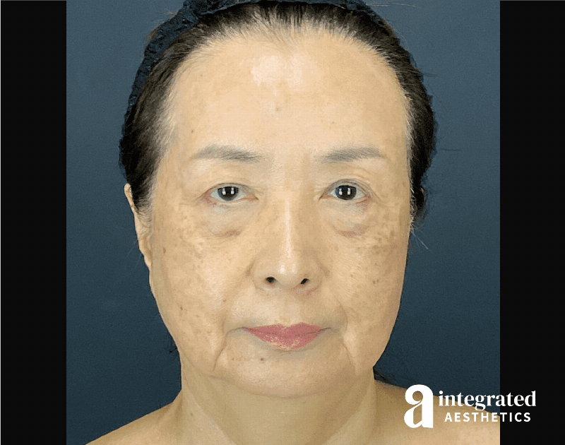 Facelift & Neck Lift Before & After Gallery - Patient 423746 - Image 1