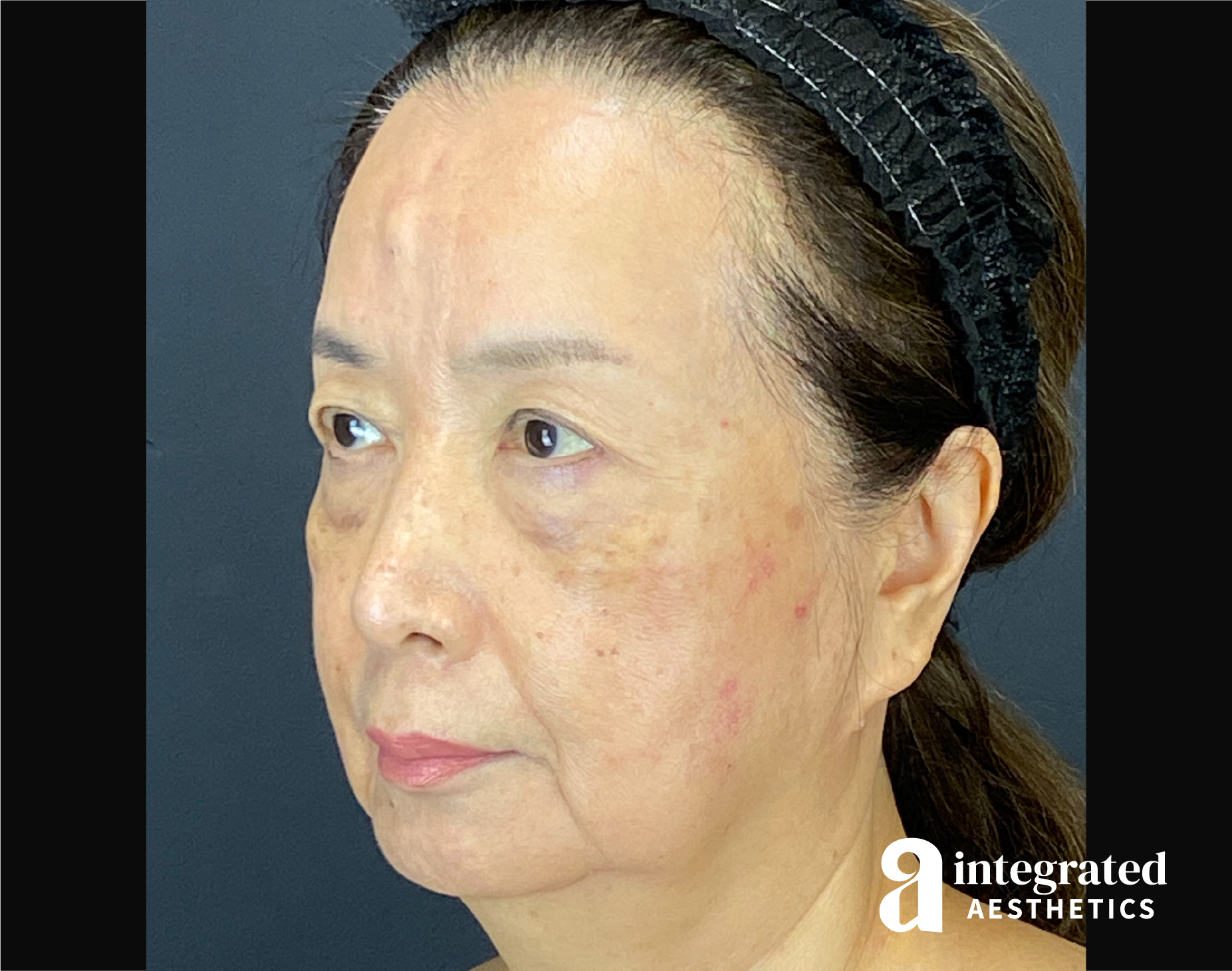 Facelift & Neck Lift Before & After Gallery - Patient 423746 - Image 5