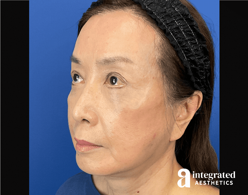 Facelift & Neck Lift Before & After Gallery - Patient 423746 - Image 6