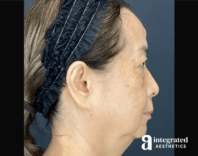 Facelift & Neck Lift Before & After Gallery - Patient 423746 - Image 9