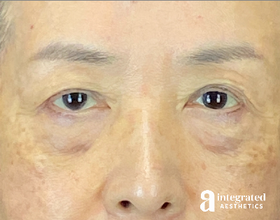 Brow Lift Before & After Gallery - Patient 354679 - Image 1