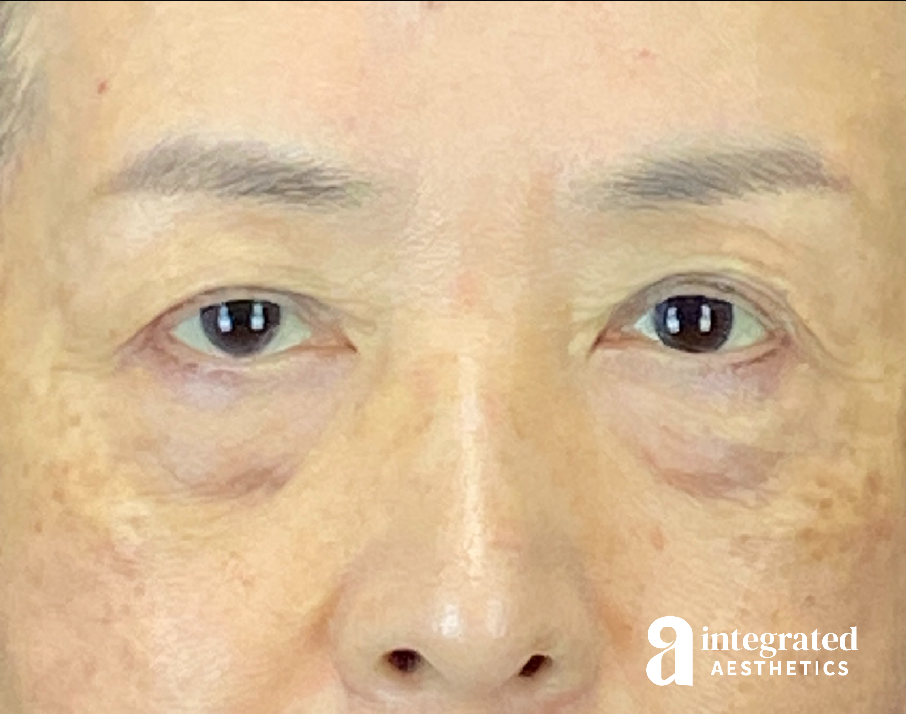 Blepharoplasty Before & After Gallery - Patient 275563 - Image 1