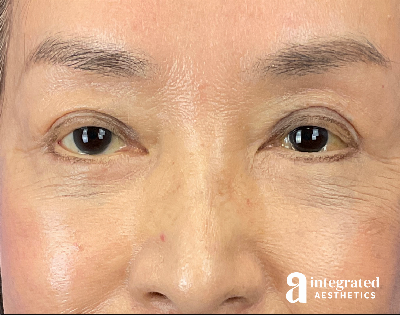 Brow Lift Before & After Gallery - Patient 354679 - Image 2