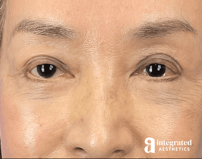 Brow Lift Before & After Gallery - Patient 354679 - Image 2