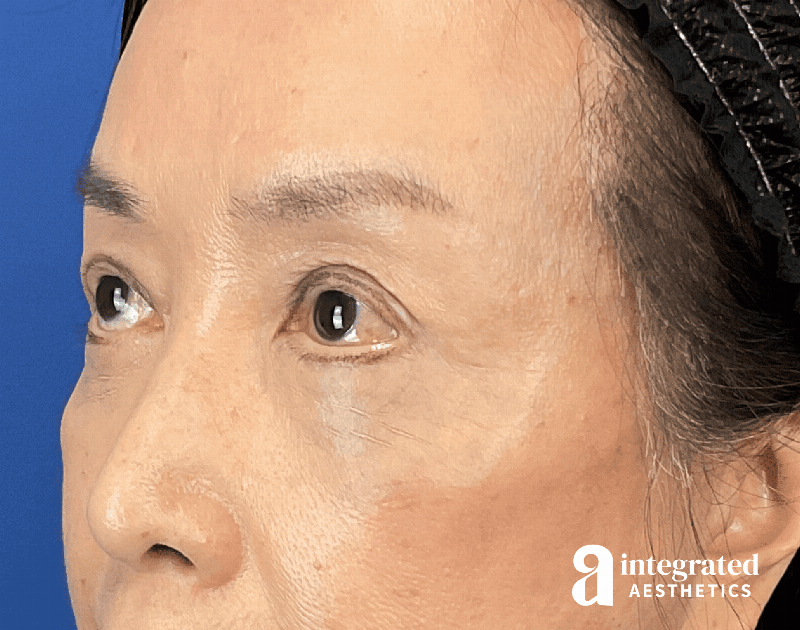 Brow Lift Before & After Gallery - Patient 354679 - Image 6