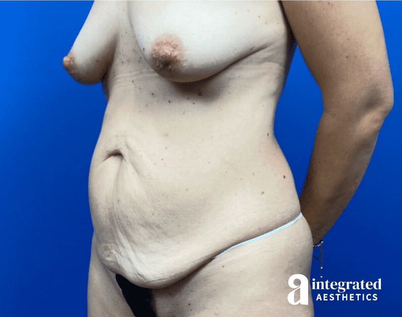 Tummy Tuck Before & After Gallery - Patient 480249 - Image 5