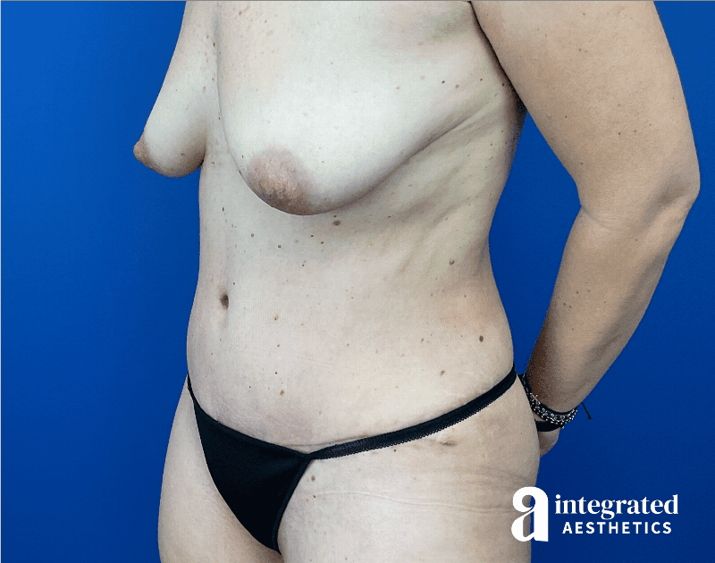 Tummy Tuck Before & After Gallery - Patient 480249 - Image 6