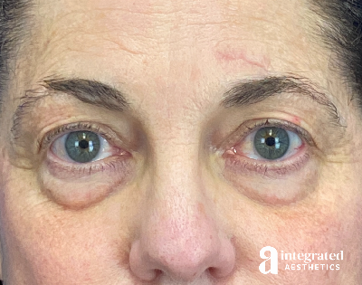 Blepharoplasty Before & After Gallery - Patient 272173 - Image 1