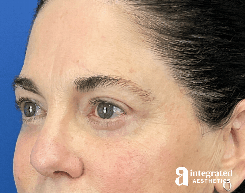 Blepharoplasty Before & After Gallery - Patient 272173 - Image 6