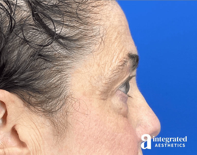 Blepharoplasty Before & After Gallery - Patient 272173 - Image 7