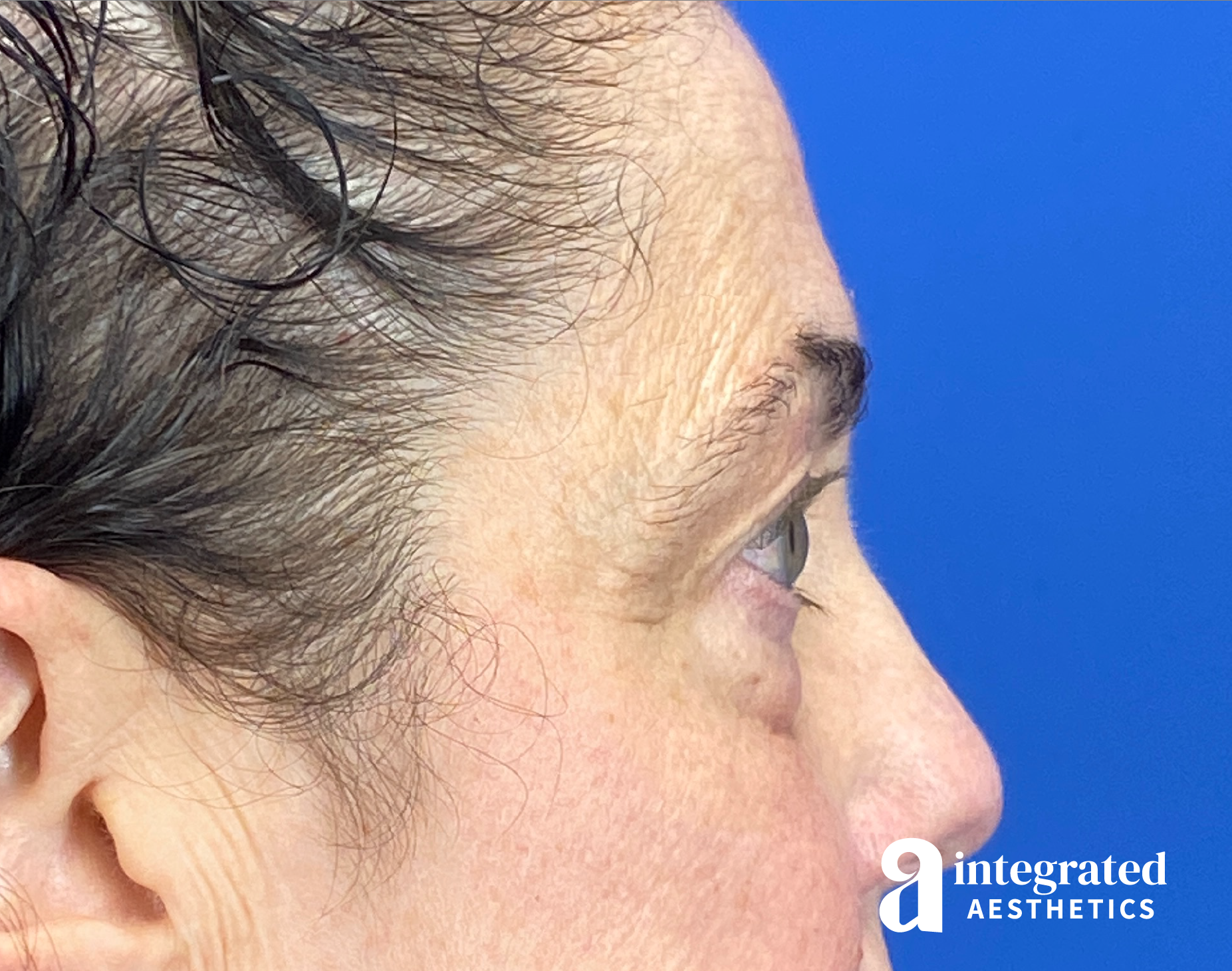 Blepharoplasty Before & After Gallery - Patient 272173 - Image 7