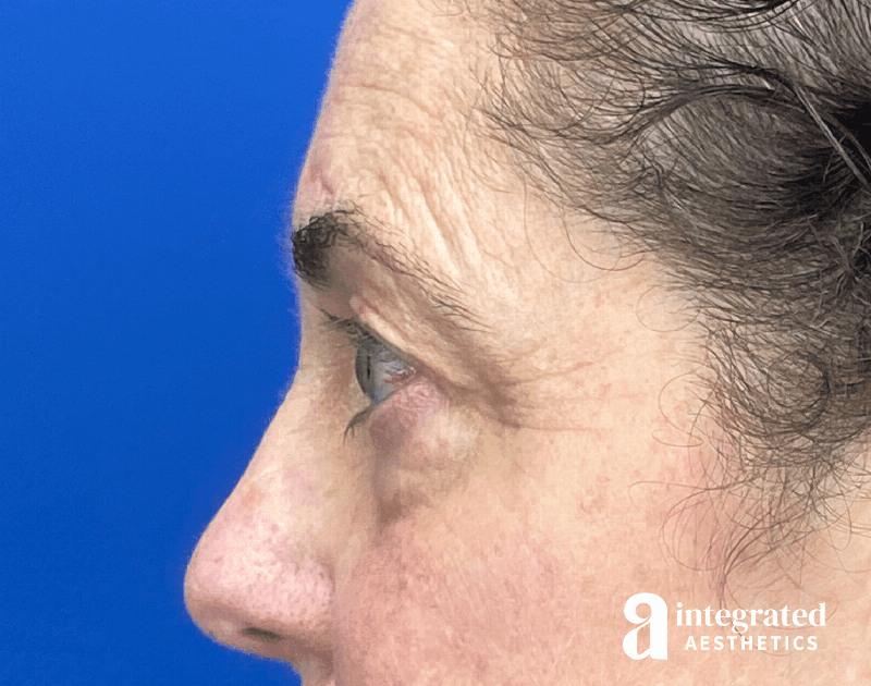 Blepharoplasty Before & After Gallery - Patient 272173 - Image 9