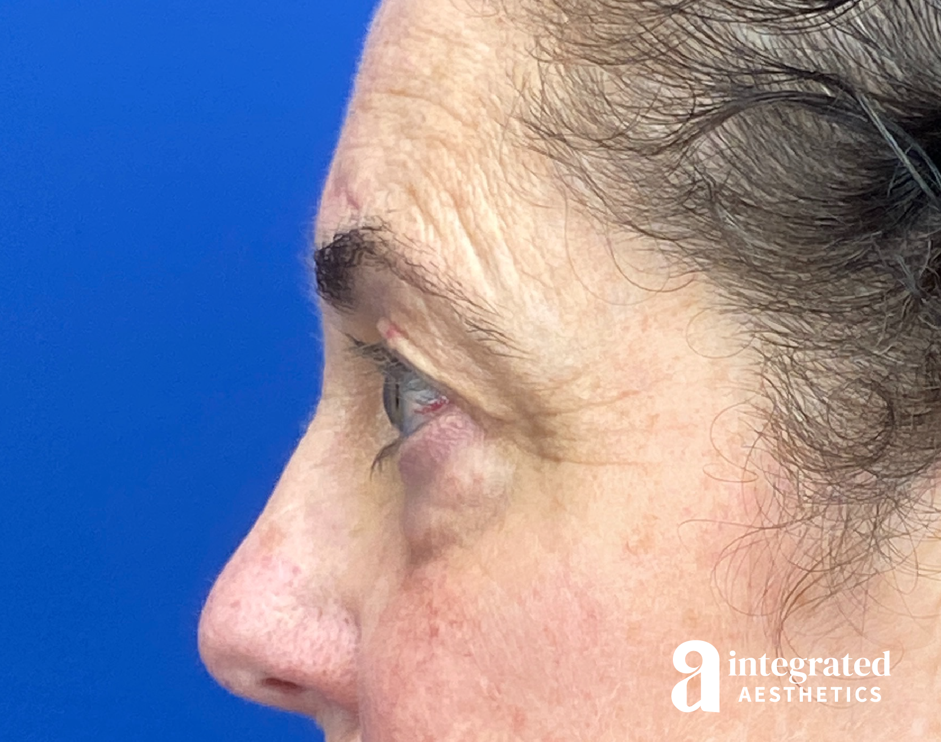 Blepharoplasty Before & After Gallery - Patient 272173 - Image 9