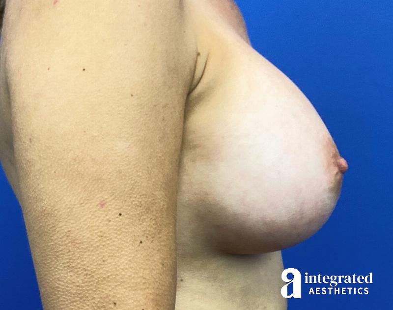 Breast Augmentation Before & After Gallery - Patient 364732 - Image 8