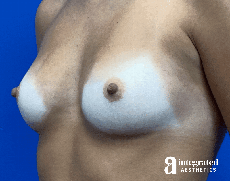 Breast Augmentation Before & After Gallery - Patient 902409 - Image 5