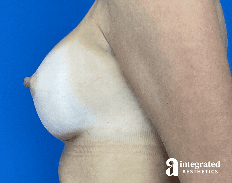 Breast Augmentation Before & After Gallery - Patient 902409 - Image 10