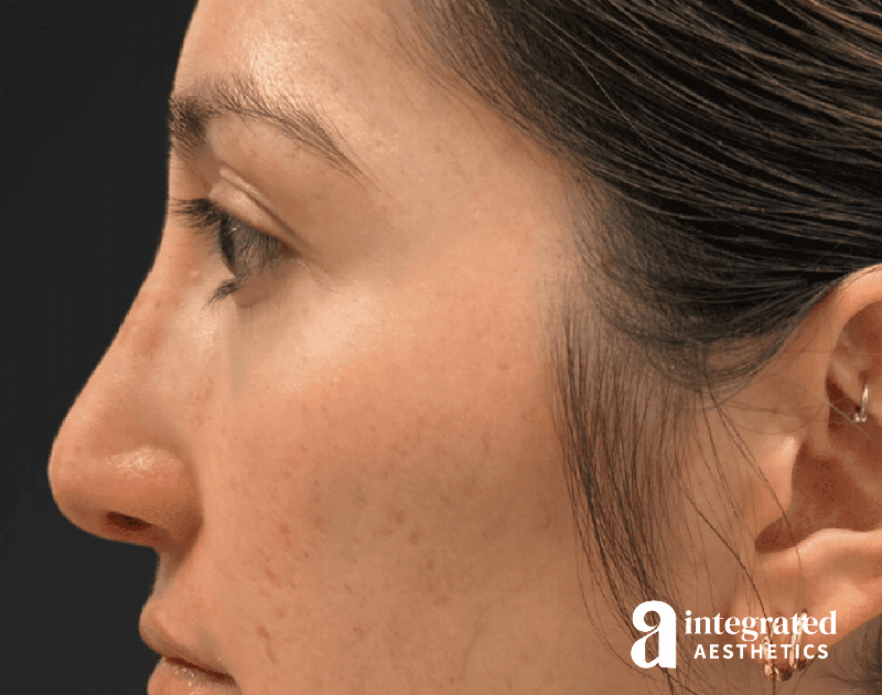 Rhinoplasty Before & After Gallery - Patient 114687 - Image 2