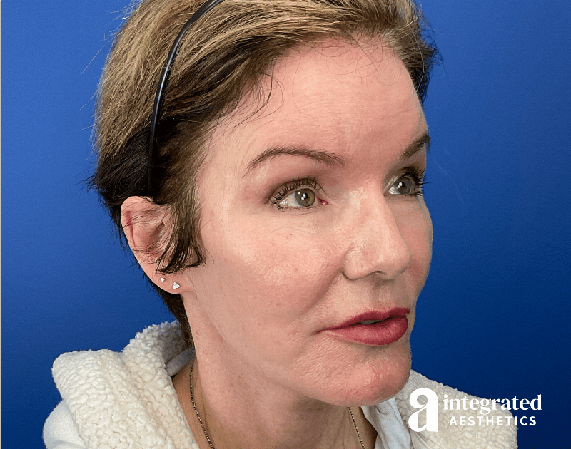 Suture Lift Before & After Gallery - Patient 402391 - Image 4