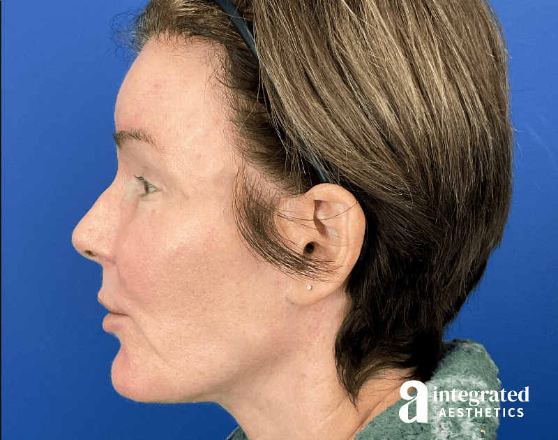 Suture Lift Before & After Gallery - Patient 402391 - Image 9