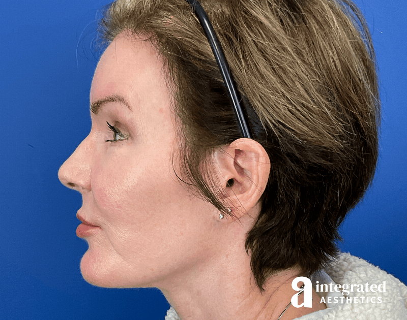 Suture Lift Before & After Gallery - Patient 402391 - Image 10