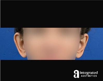 Otoplasty Before & After Gallery - Patient 153382 - Image 1