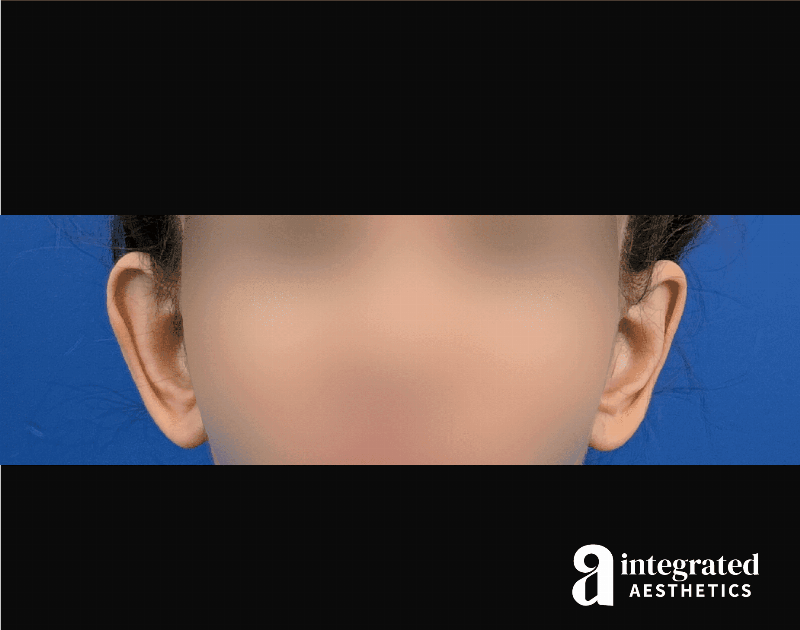 Otoplasty Before & After Gallery - Patient 153382 - Image 1