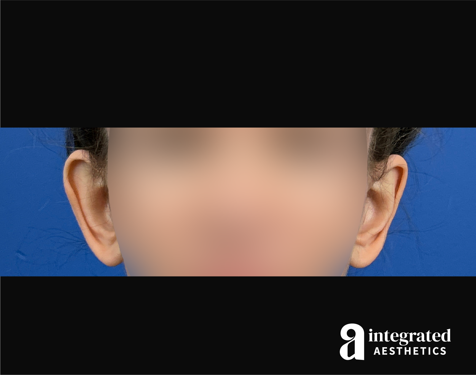 Otoplasty Before & After Gallery - Patient 153382 - Image 1