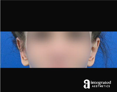 Otoplasty Before & After Gallery - Patient 153382 - Image 2