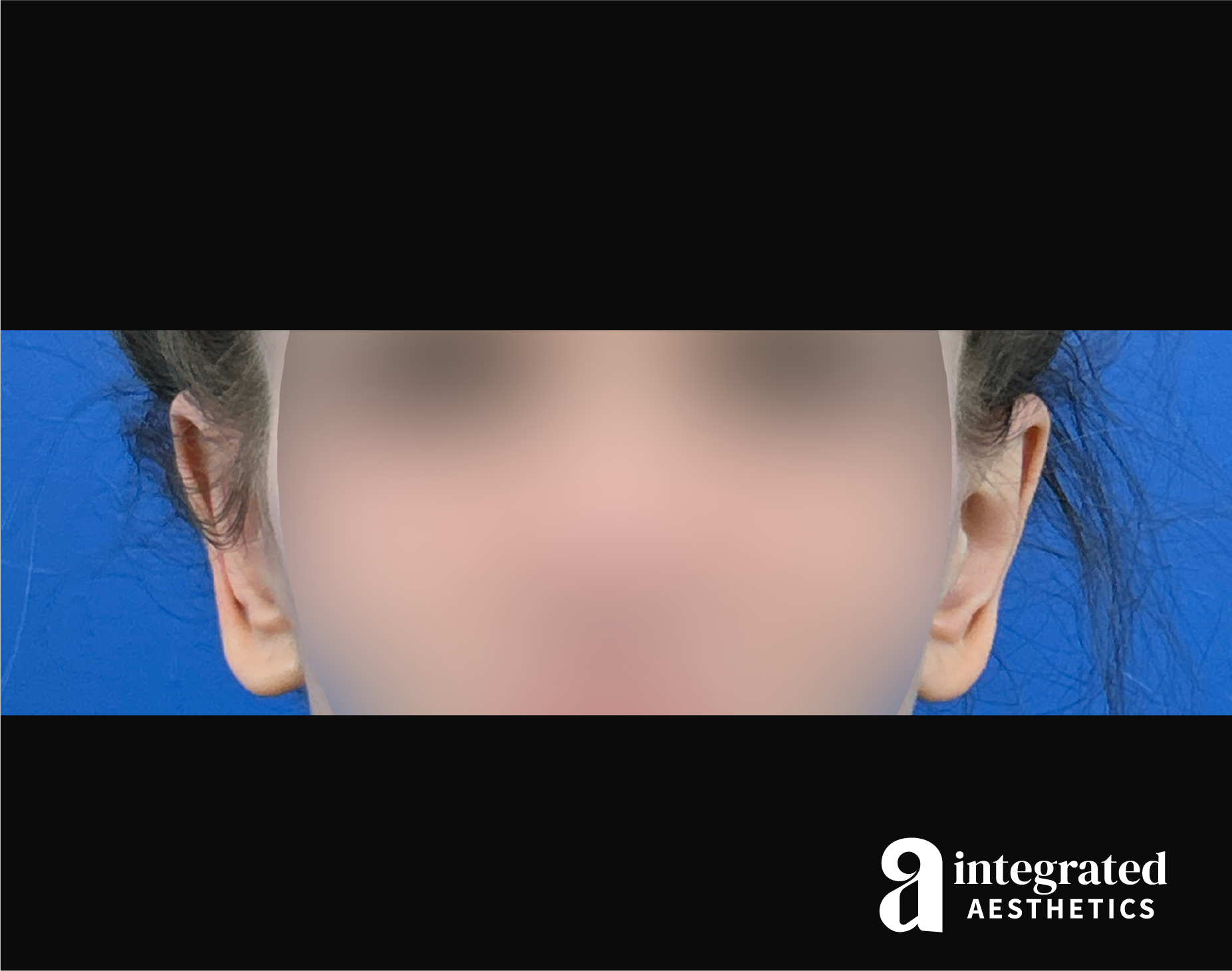 Otoplasty Before & After Gallery - Patient 153382 - Image 2