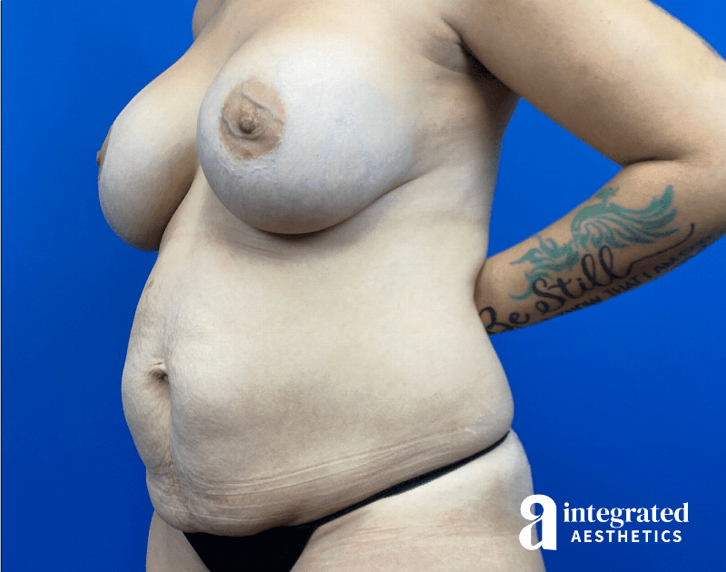 Tummy Tuck Before & After Gallery - Patient 817753 - Image 5