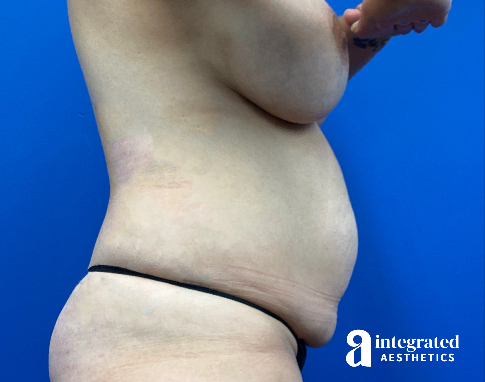 Tummy Tuck Before & After Gallery - Patient 817753 - Image 13