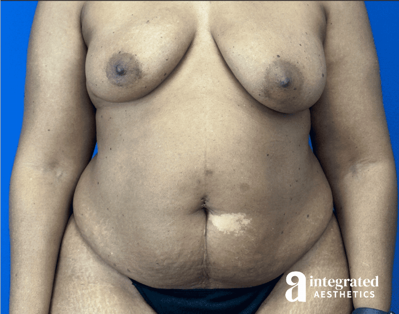 Tummy Tuck Before & After Gallery - Patient 100082 - Image 1