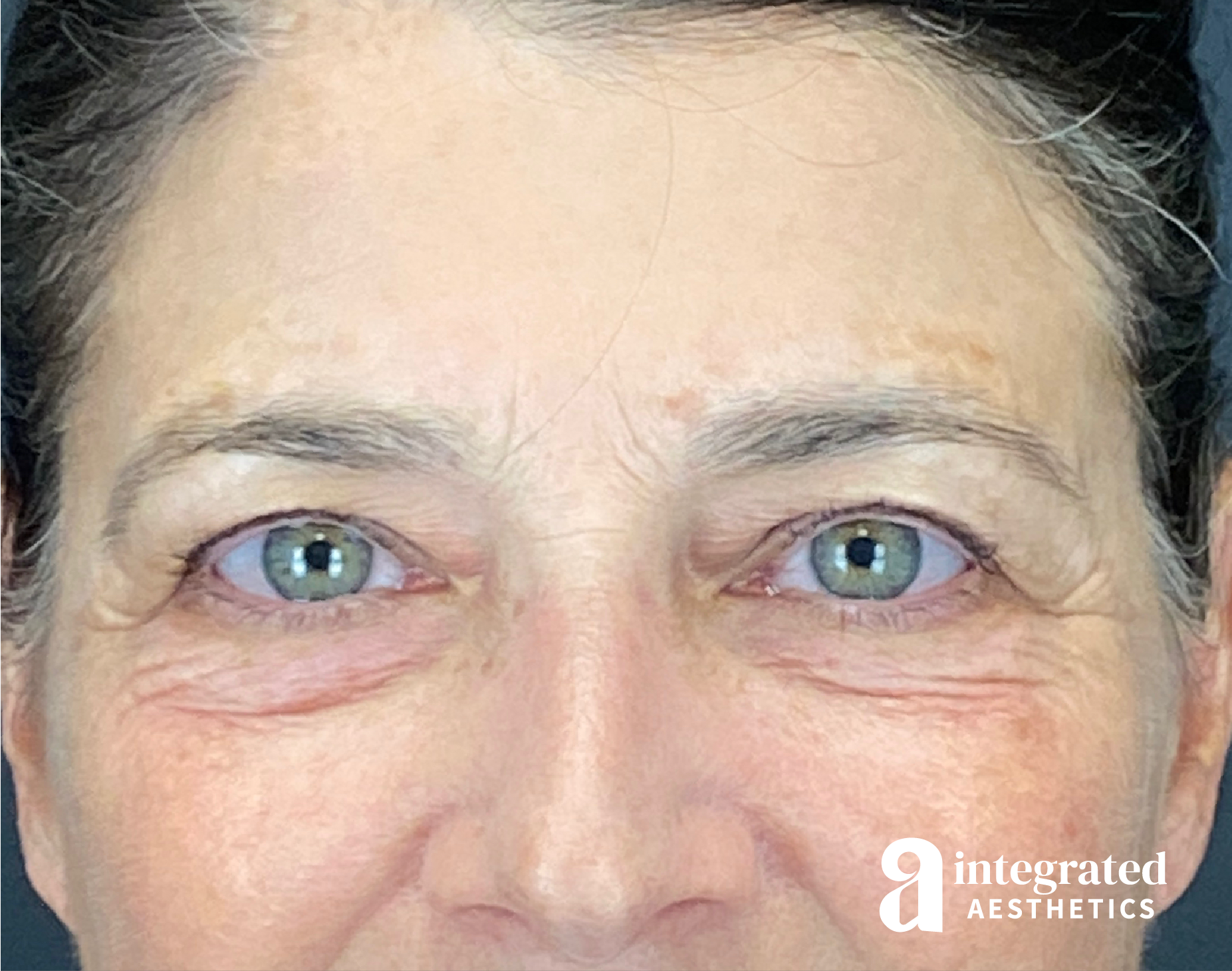 Blepharoplasty Before & After Gallery - Patient 310745 - Image 1