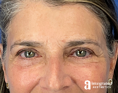 Blepharoplasty Before & After Gallery - Patient 310745 - Image 2