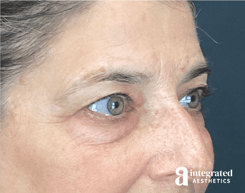 Blepharoplasty Before & After Gallery - Patient 310745 - Image 3