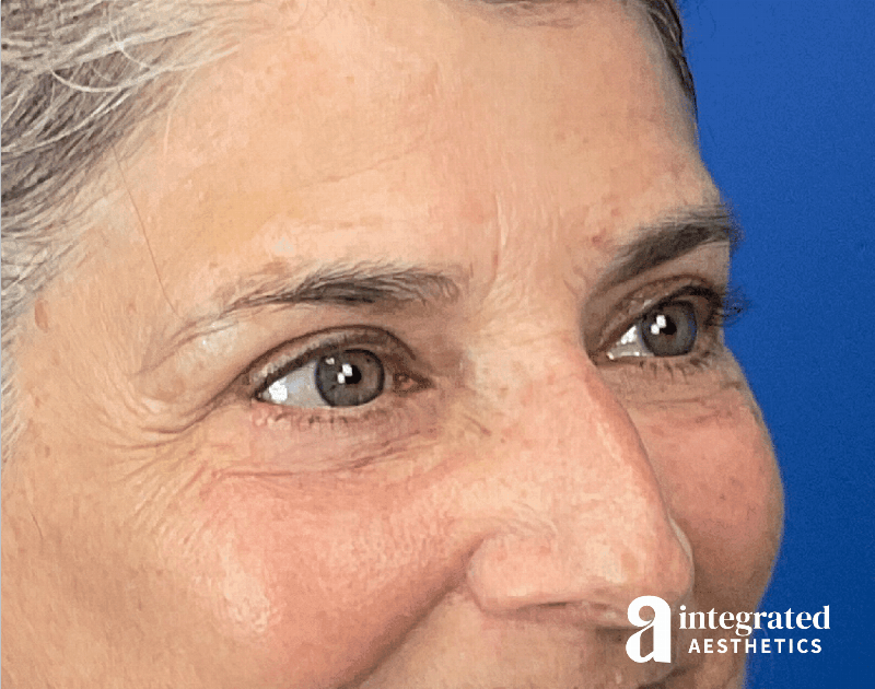 Blepharoplasty Before & After Gallery - Patient 310745 - Image 4