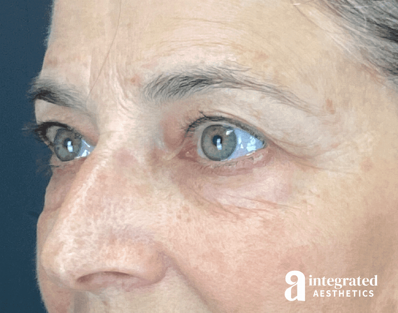 Blepharoplasty Before & After Gallery - Patient 310745 - Image 5