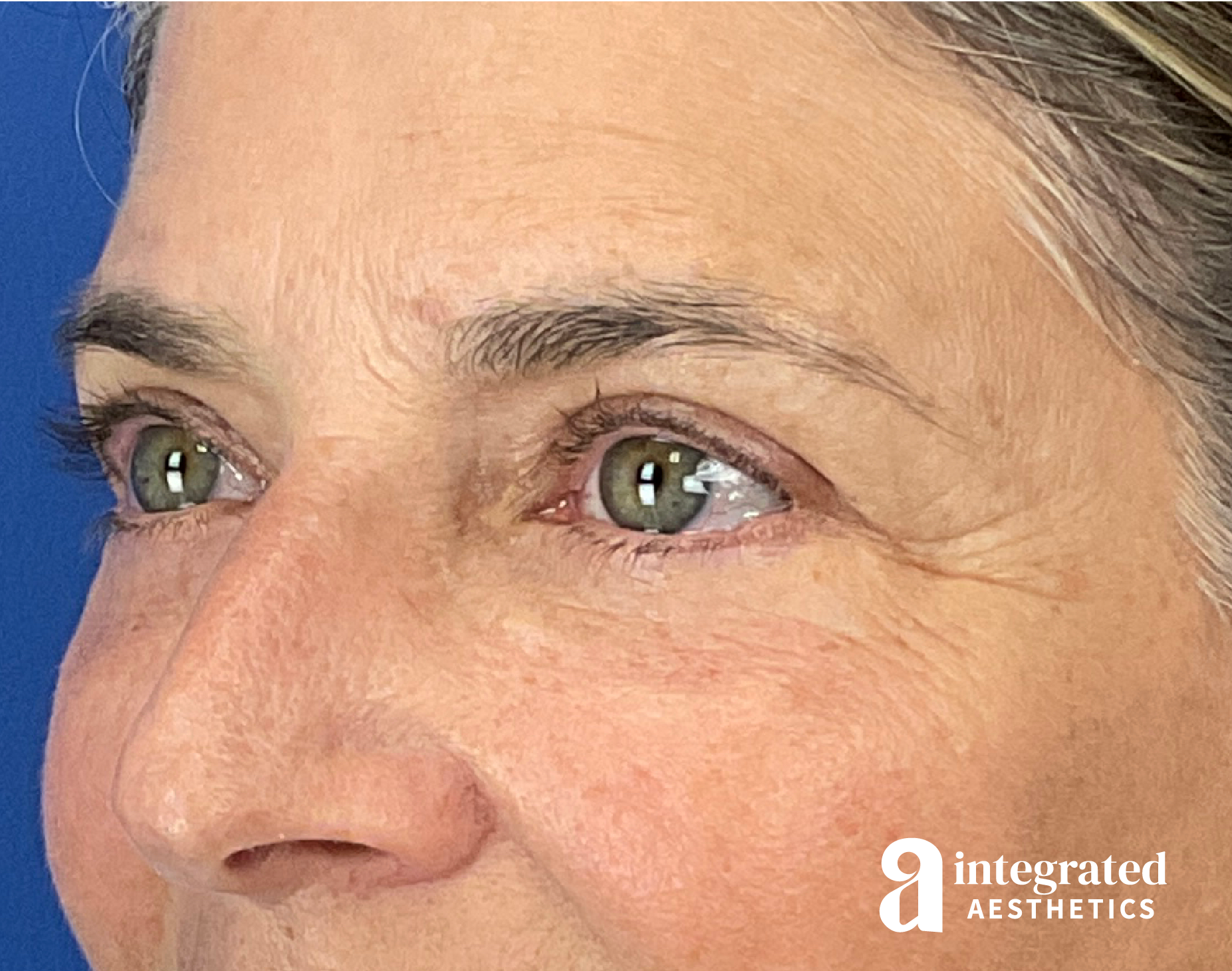 Blepharoplasty Before & After Gallery - Patient 310745 - Image 6