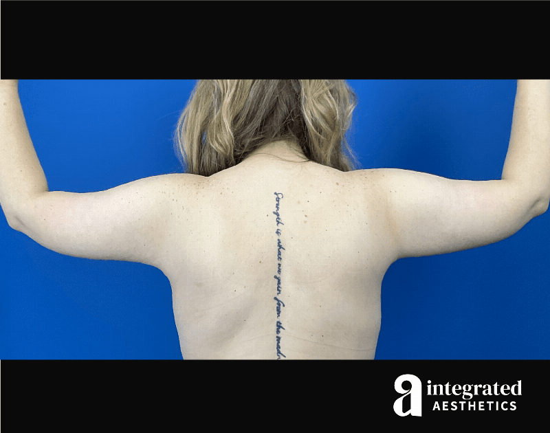 Brachioplasty Before & After Gallery - Patient 193246 - Image 2