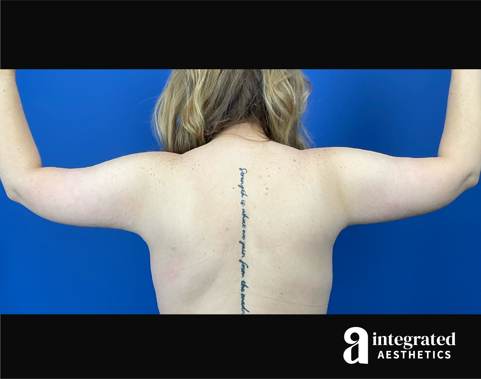 Brachioplasty Before & After Gallery - Patient 193246 - Image 2