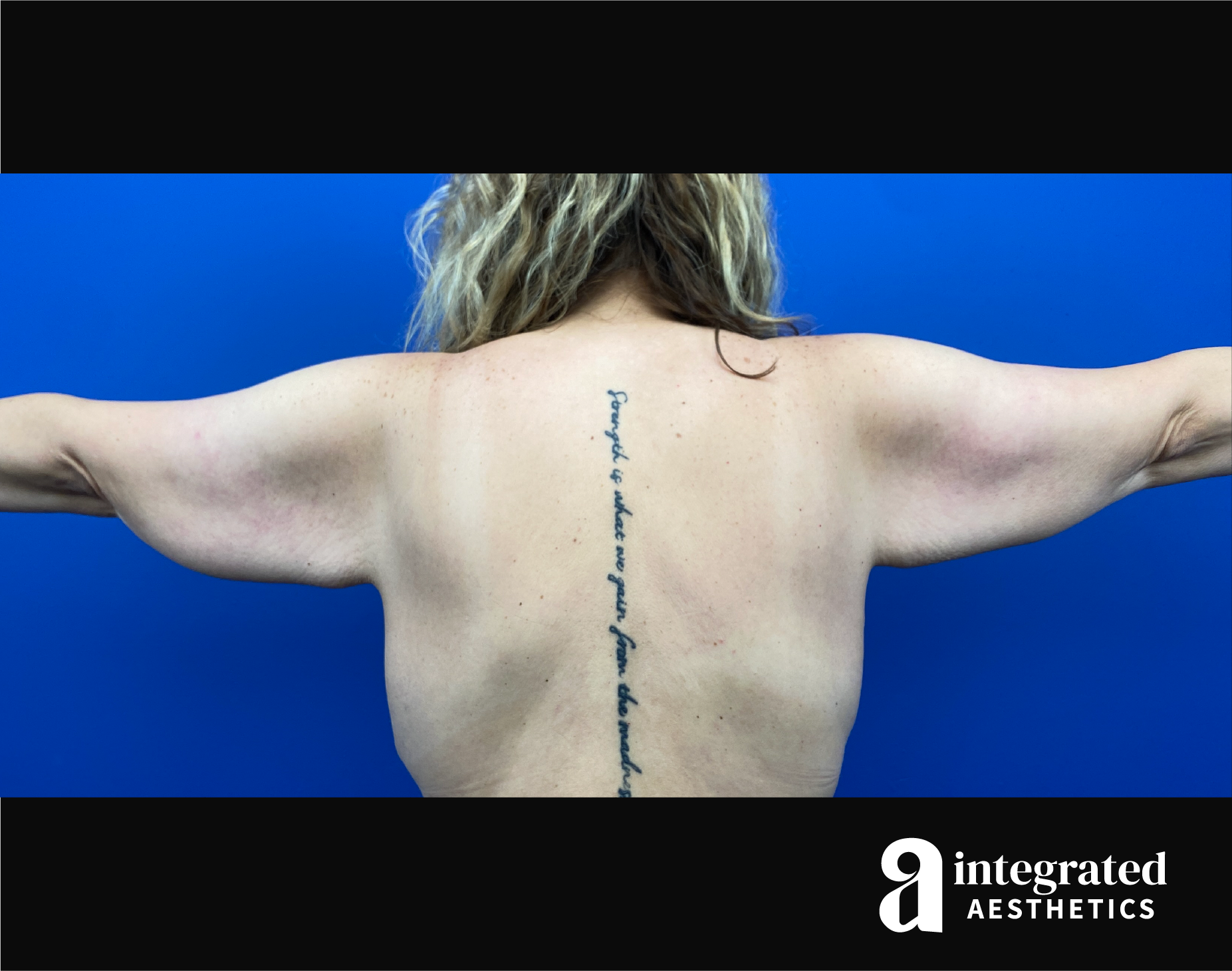 Brachioplasty Before & After Gallery - Patient 193246 - Image 3