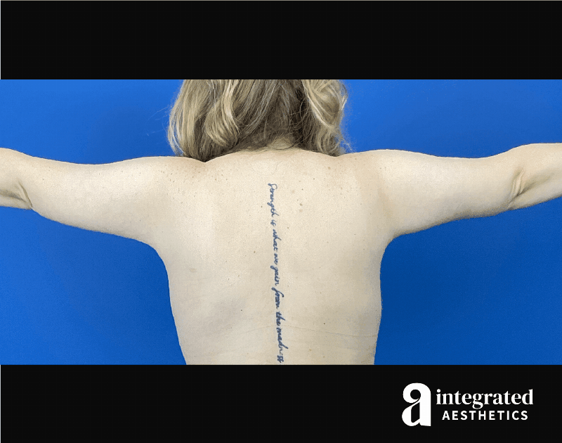 Brachioplasty Before & After Gallery - Patient 193246 - Image 4