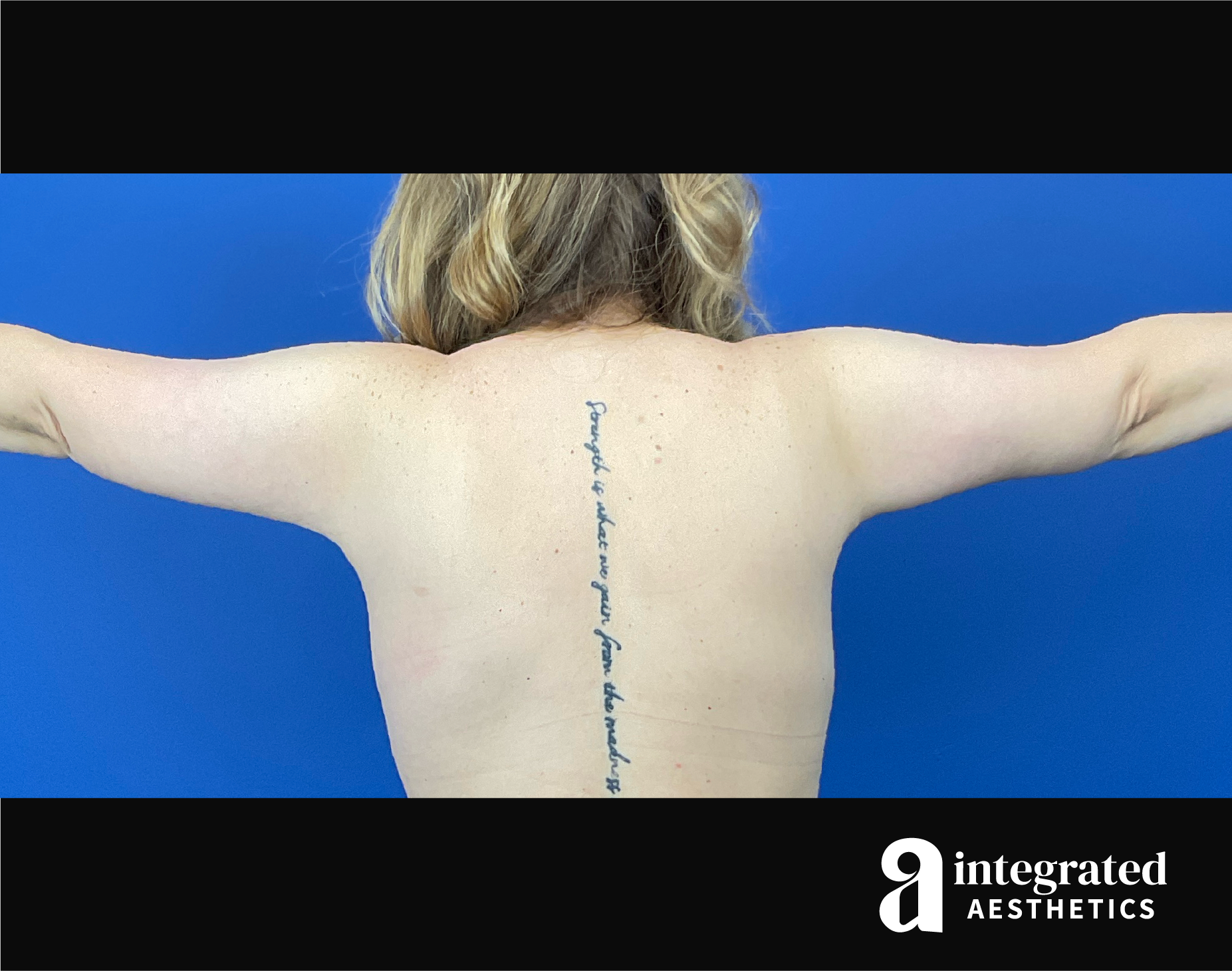 Brachioplasty Before & After Gallery - Patient 193246 - Image 4