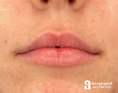 Lip Filler Before & After Gallery - Patient 320036 - Image 1